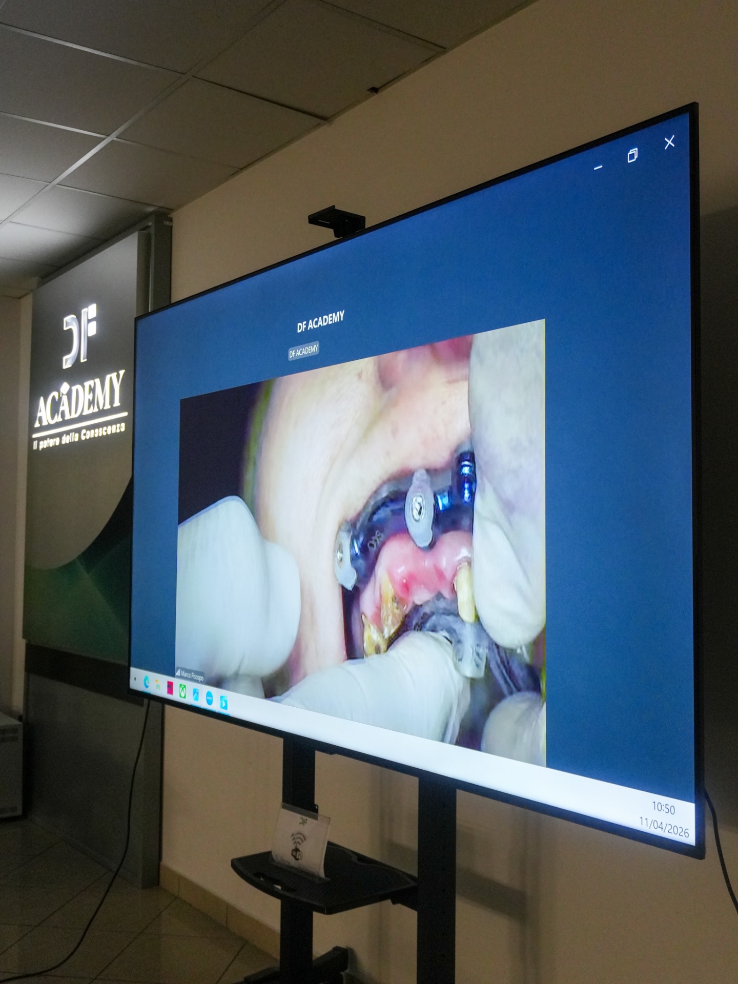 Live surgery: posizionamento implantare proiettato in sala